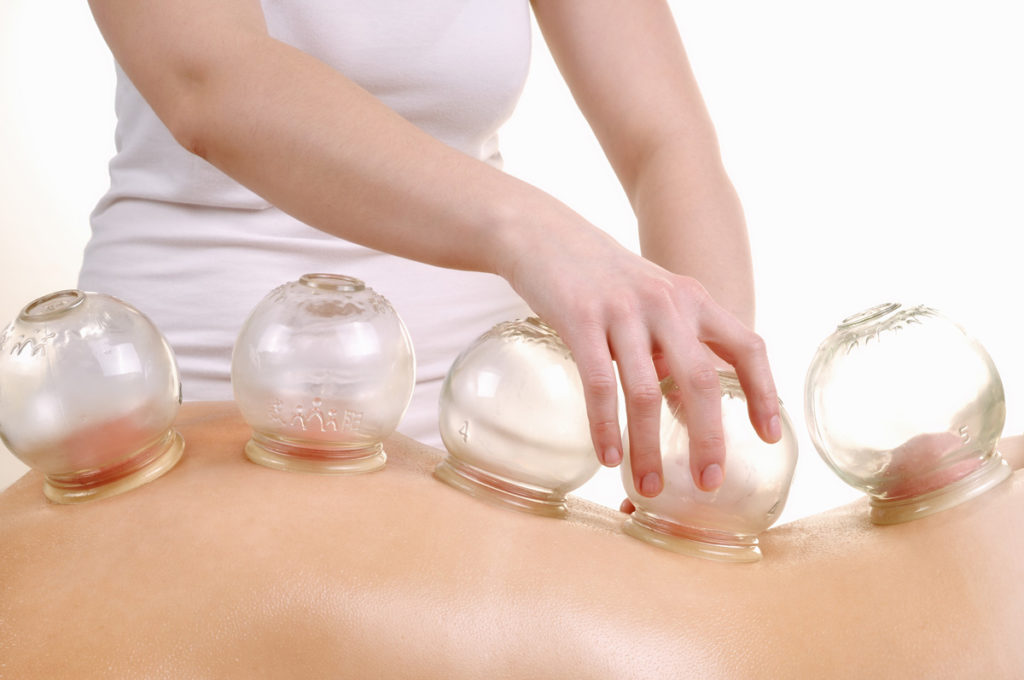 Woman receiving cupping treatment